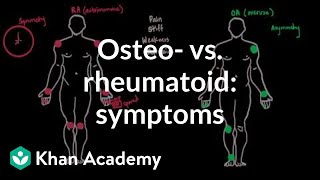 6 Criteria To Diagnose Rheumatoid Arthritis [upl. by Assenev275]