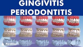 Gingivitis and Periodontitis  Evolution © [upl. by Elleunamme]