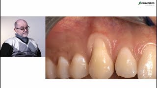 Prof Giovanni Zucchelli Treatment of class I gingival recession [upl. by Yelena]