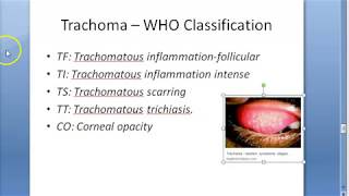 Ophthalmology 076 d Trachoma WHO Classification FISTO [upl. by Etty]