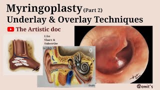 Overlay amp Underlay Techniques  Myringoplasty Part 2 [upl. by Gerhard978]