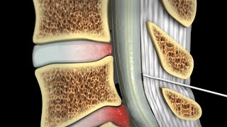 Epidural Steroid Injections [upl. by Kerek]