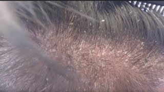 SCALP PSORIASIS  I REALLY SHOULD JUST SHAVE MY HEAD [upl. by Hahn]