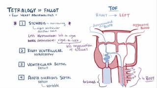 Tetralogy of fallot TOF repair causes symptoms amp pathology [upl. by Aldwin923]