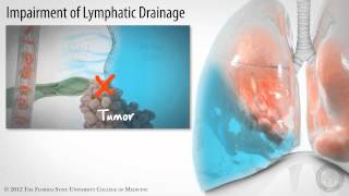 Pleural Space Part 3 of 3 Pleural Effusions HD [upl. by Rebbecca]