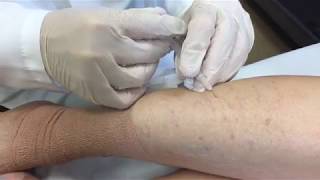 Treating Varicose Veins  SLUCare Vascular Surgery [upl. by Ynnub]