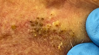 Extremely Clogged Pores Extracted  Contour Dermatology [upl. by Aisnetroh433]