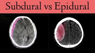 Subdural vs Epidural HematomaHemorrhage CT Scan Findings [upl. by Eirrehs]