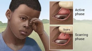 Trachoma  a very common infectious eye disease [upl. by Vitalis976]