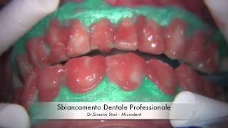 Sbiancamento Professionale dei Denti Teeth Whitening [upl. by Odrawde791]