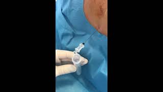 LP Lumbar puncture for meningitis diagnosis [upl. by Malvie]