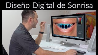 ¿Cómo se hace un diseño de sonrisa Diseño de sonrisa Digital [upl. by Grace]