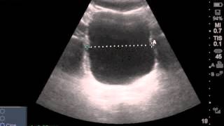 Ultrasound Estimated PostVoid Residual Bladder [upl. by Aietal]