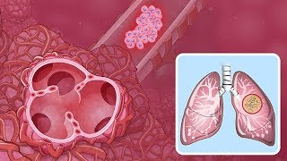 What are Sarcomas  Pathology mini tutorial [upl. by Naj207]