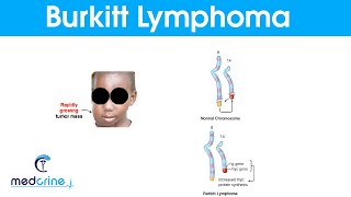 Burkitts LymphomaCauses  Symptoms and Treatment [upl. by Arratal]