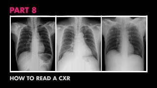 Diaphragms and Pleural Effusion  How to Read a Chest XRay Part 8  MEDZCOOL [upl. by Mairem]