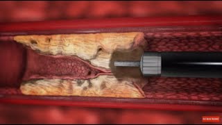 TurboElite laser atherectomy animation [upl. by Cirdahc178]