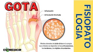 FISIOPATOLOGÍA GOTA  Dr Tlatempa [upl. by Cavuoto]