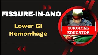 FISSURE IN ANO How To DIAGNOSE amp TREAT Lower GI Hemorrhage [upl. by Sairu505]