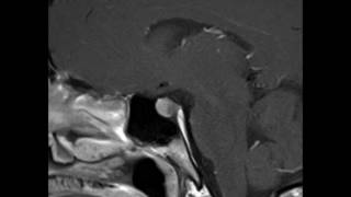 Pituitary Microadenoma [upl. by Abby]