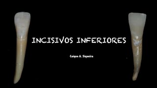 Incisivos Inferiores Incisivo Central e Lateral Inferior  Anatomia Dental [upl. by Vilberg]