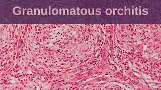 Idiopathic Granulomatous Orchitis  Pathology mini tutorial [upl. by Shaya242]