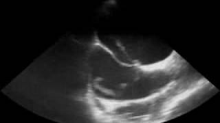 Thrombus in a Patent Foramen Ovale [upl. by Enahsed]