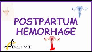 Postpartum Hemorrhage PPH causesrisk factorsprevention and treatment [upl. by Nyletac]