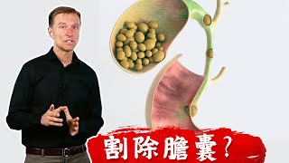 結石2 膽結石要割除膽囊嗎？ 膽結石原因？吃什麼飲食溶解結石？柏格醫生dr berg [upl. by Atinel]