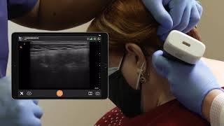 Scanning Technique Occipital Nerve Block [upl. by Trude]