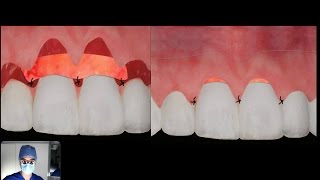 How does a CONNECTIVE TISSUE graft work [upl. by Eppesuig]