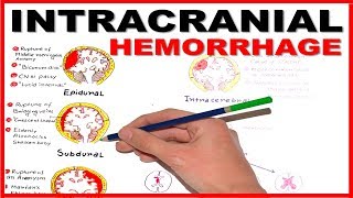 Intracranial Hemorrhage EpiduralSubduralSubarachnoid overview [upl. by Nevetse]