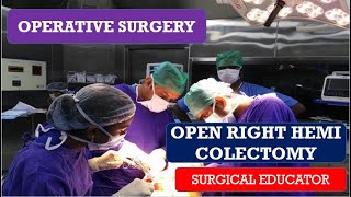 OPEN RIGHT HEMICOLECTOMY STEP BY STEP OPERATIVE SURGERY [upl. by Nesline625]