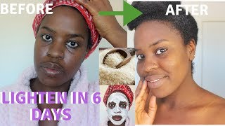 How I How i BRIGHTENED MY SKIN IN 6 DAYS REALISTIC and Natural way to reduce hyperpigmentation [upl. by Weisman]