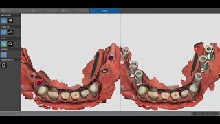 CS3600 Multi scanbody implant capture Carestream Dental [upl. by Arnon]