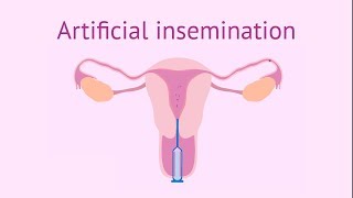 Artificial insemination [upl. by Carlynne]