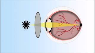 Presbyopia Explained Annimated Video [upl. by Matrona]