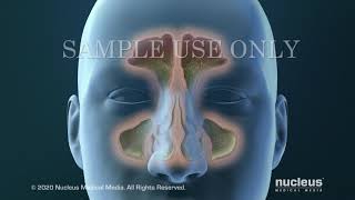 Sinusitis Surgery [upl. by Ellemac]