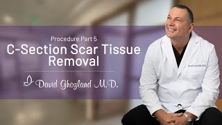 CSection Scar Tissue Removal  Procedure Part 5  David Ghozland MD [upl. by Anitsenre]