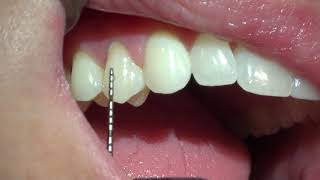 How to Measure Gingival Recession [upl. by Zerimar635]