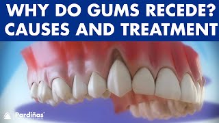 Gum recession  Treatment of gingival retraction © [upl. by Leunamnauj]