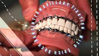 Intermaxillary Fixation with Erich Arch Bars [upl. by Gadmann]