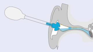 earClin earshower  how to use [upl. by Cinimod790]