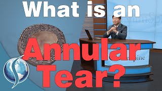 What Is An Annular Tear [upl. by Gnni]