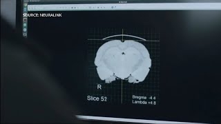 Musk’s Neuralink First Patient Receives Brain Implant [upl. by Pauline]