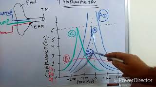 Tympanometry Impedance Audiometry [upl. by Haakon]