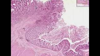 Histopathology ColonAdenocarcinoma [upl. by Aicemed]