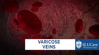 How to Treat Varicose Veins Naturally – Dr Berg [upl. by Amitaf932]