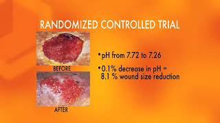 Medihoney Debridement [upl. by Rotsen]