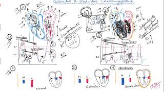 Restrictive vs Constrictive cardiomyopathy [upl. by Atinar]